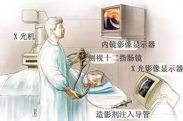 患者点赞！这项技术无创巧取结石！