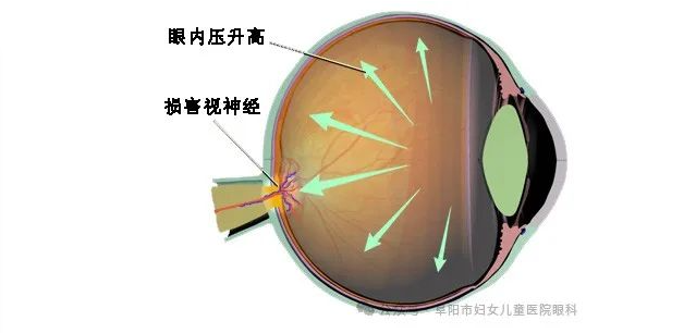 重视青光眼，防止视功能损伤