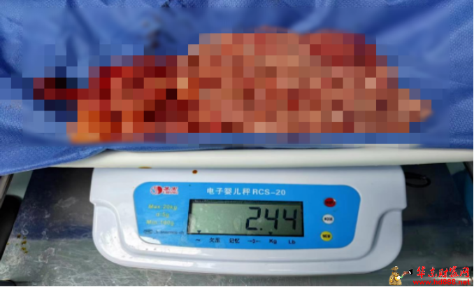 近5斤！阜阳一女子肚中取出...市妇女儿童医院医生紧急提醒