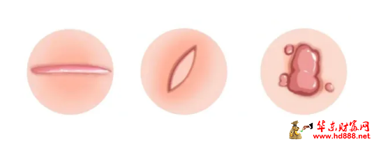 【直播预告】疤痕“消消乐”：从正确预防到科学修复