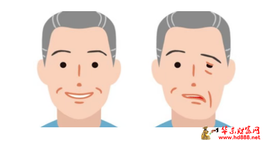 从歪嘴到微笑：面瘫中医康复全攻略