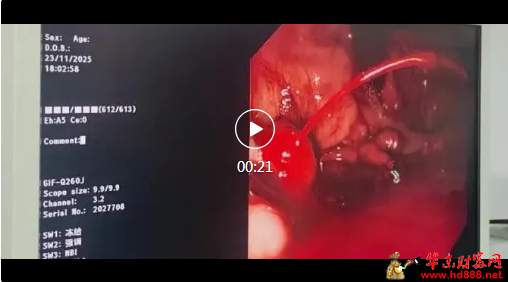 胃底的&ldquo;小喷泉&rdquo;止住了