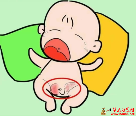 【直播预告】宝宝腹股沟鼓包？小心斜疝！