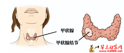 【直播预告】聊聊甲状腺那些事，甲状腺结节的监测和治疗