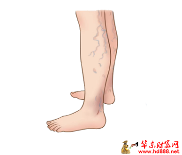 【直播预告】腿上青筋凸起，是累的还是病？今天17点，医生带您一探究&ldquo;静&rdquo;！