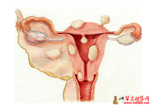 【直播预告】子宫肌瘤别慌！妇科大咖带你从检查到治疗全理清