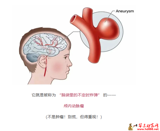 【直播预告】脑袋里的 &ldquo;不定时炸弹&rdquo;&nbsp;，你了解吗?