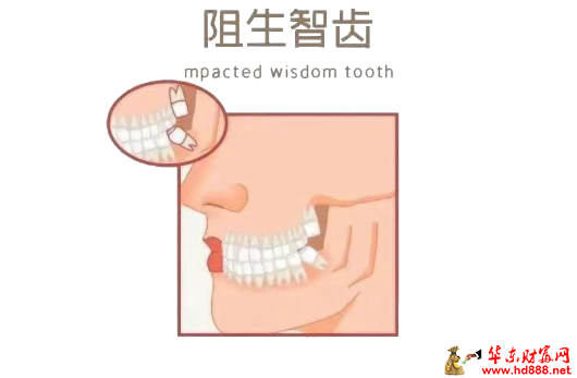 【直播预告】反复发炎、牙龈肿痛？小心是阻生牙在作怪