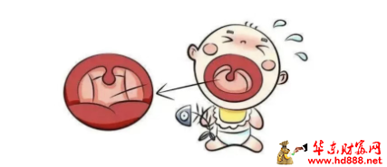 直播预告】咽喉、气管、食管异物误入的注意事顶
