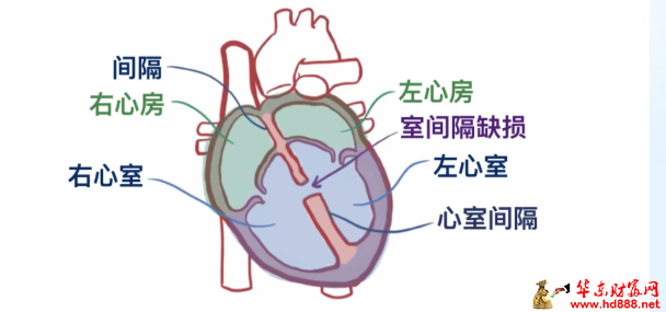 一&ldquo;孔&rdquo;之隔，微创&ldquo;补心&rdquo;&mdash;&mdash;阜阳市第六人民医院心脏大血管外科成功完成经皮室间隔缺损封堵术
