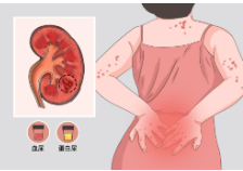【直播预告】红斑狼疮伤肾怎么办?  带你认识狼疮性肾炎