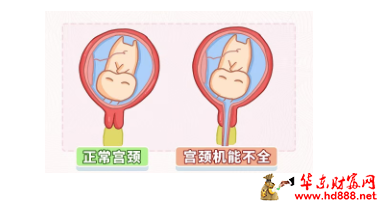 小小的环扎线，托起了她稳稳的幸福：我院产科助宫颈机能不全孕妈顺利分娩